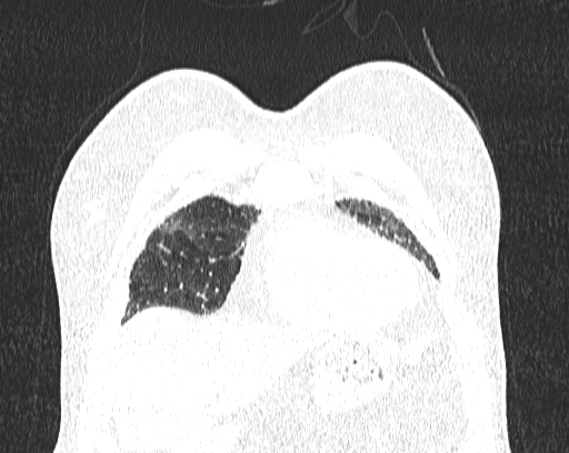 Non-specific interstitial pneumonia (NSIP) (Radiopaedia 68599-78228 Coronal lung window 9).jpg