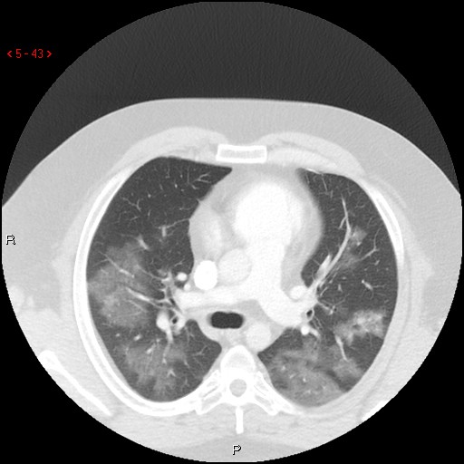 File:Non-specific interstitial pneumonitis (Radiopaedia 27044-27222 Axial lung window 34).jpg