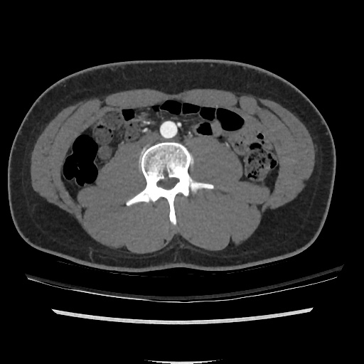 File:Normal CT angiogram of pelvis (Radiopaedia 45390-49430 A 8).jpg