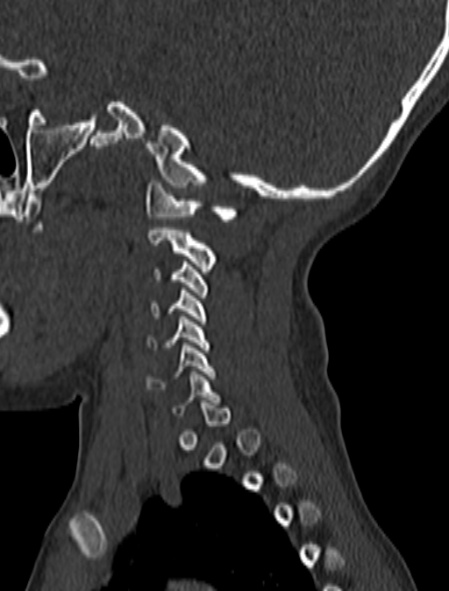 Normal CT cervical spine - pediatric (Radiopaedia 52549-58462 Sagittal bone window 171).jpg