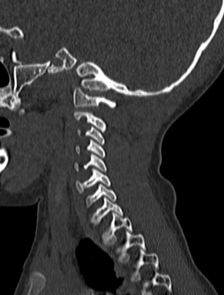 Normal CT cervical spine - pediatric (Radiopaedia 52549-58462 Sagittal bone window 44).jpg
