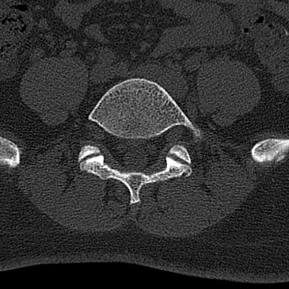 File:Normal CT lumbar spine (Radiopaedia 53981-60118 Axial bone window 60).jpg