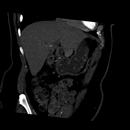 File:Normal CT renal artery angiogram (Radiopaedia 38727-40889 D 1).png