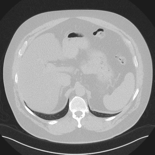 Normal HRCT (Radiopaedia 40797-43458 Axial lung window 57).png