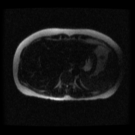 File:Normal MRCP (Radiopaedia 41966-44978 Axial T2 thins 30).png