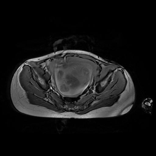 File:Normal MRI abdomen in pregnancy (Radiopaedia 88001-104541 Axial Gradient Echo 46).jpg