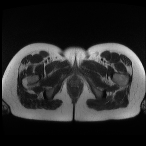 Normal MRI abdomen in pregnancy (Radiopaedia 88003-104546 Axial T2 53).jpg