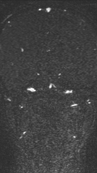 Normal MRI brain with MRV- teenager (Radiopaedia 49425-54553 Coronal MRV 133).jpg