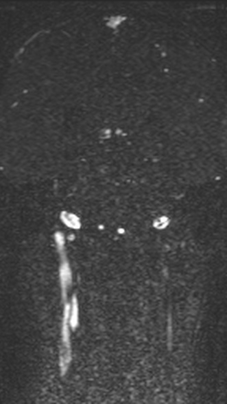 Normal MRI brain with MRV- teenager (Radiopaedia 49425-54553 Coronal MRV 155).jpg