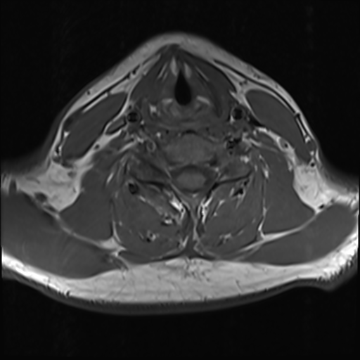 File:Normal MRI cervical spine (infection protocol) (Radiopaedia 53916-60039 Axial 33).png