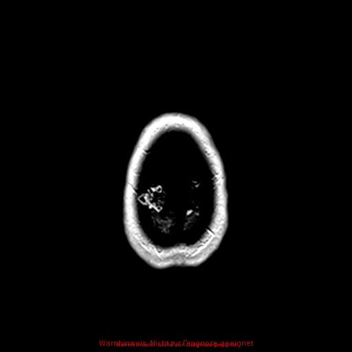Normal adult brain MRI (non-enhanced and contrast-enhanced) (Radiopaedia 75262-86379 Axial T1 C+ 175).jpg