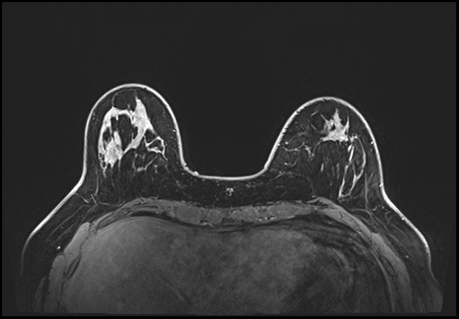 Normal breast MRI - dense breasts (Radiopaedia 80454-93850 C 58).jpg