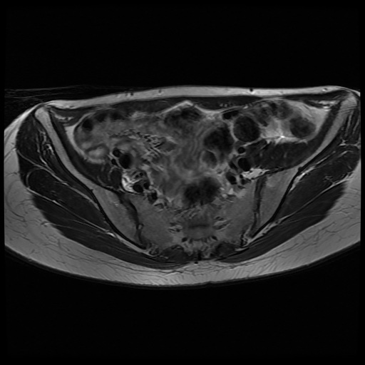 File:Normal female pelvis MRI (retroverted uterus) (Radiopaedia 61832-69933 Axial T2 11).jpg