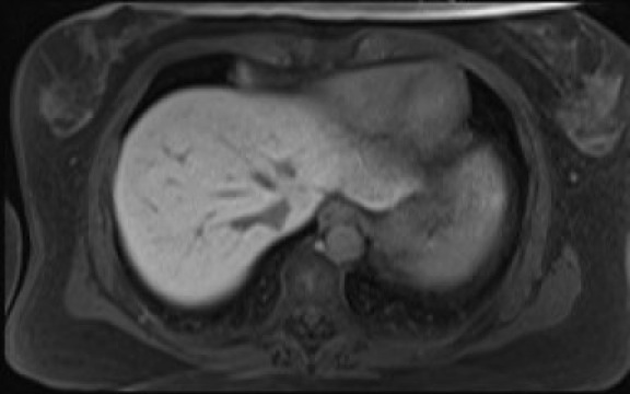 File:Normal hepatobiliary phase liver MRI (Radiopaedia 58968-66230 A 18).jpg