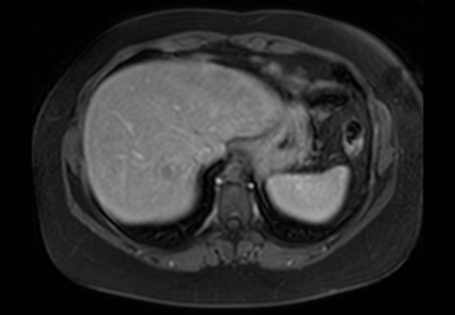 Normal liver MRI with Gadolinium (Radiopaedia 58913-66163 J 61).jpg