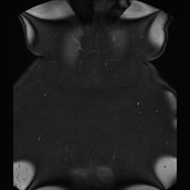 Normal liver MRI with Gadolinium (Radiopaedia 58913-66163 P 88).jpg
