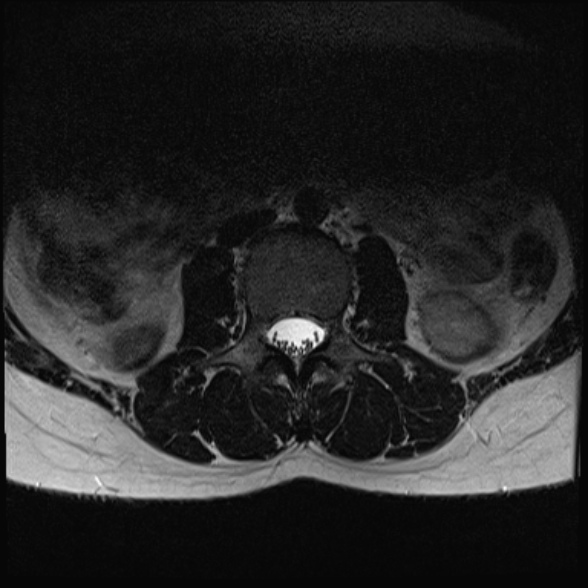 File:Normal lumbar spine MRI- 3 T (Radiopaedia 53280-59250 Axial T2 4).jpg