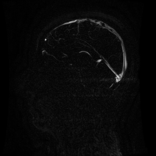 Normal noncontrast MR venography (Radiopaedia 87578-103957 A 88).jpg