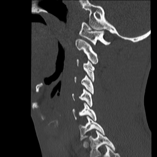 File:Normal trauma cervical spine (Radiopaedia 41017-43760 Sagittal bone window 12).png