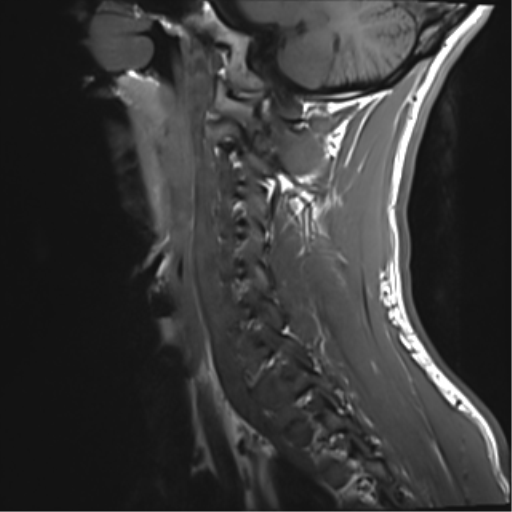 File:Normal trauma cervical spine (Radiopaedia 41017-43762 Sagittal T1 4).png