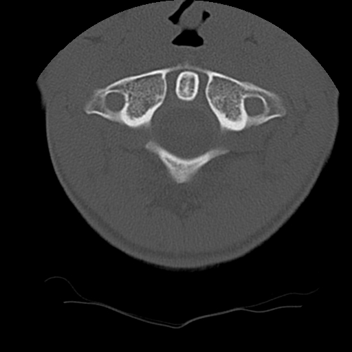 Normal trauma spine imaging (age 16) (Radiopaedia 45335-49358 Axial bone window 11).jpg