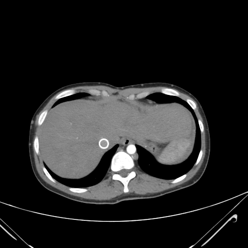 File:Nutmeg liver- Budd-Chiari syndrome (Radiopaedia 46234-50635 A 11).png