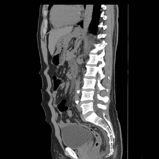File:Obstructed kidney with perinephric urinoma (Radiopaedia 26889-27066 B 38).jpg
