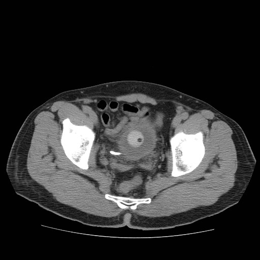 File:Obstructed kidney with perinephric urinoma (Radiopaedia 26889-27067 Axial non-contrast 48).jpg