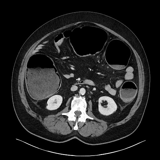 Obstructing sigmoid adenocarcinoma (Radiopaedia 58465-65619 A 76).jpg