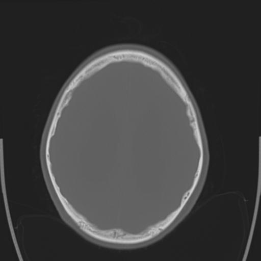 File:Obstructive hydrocephalus (Radiopaedia 30453-31119 Axial bone window 10).jpg