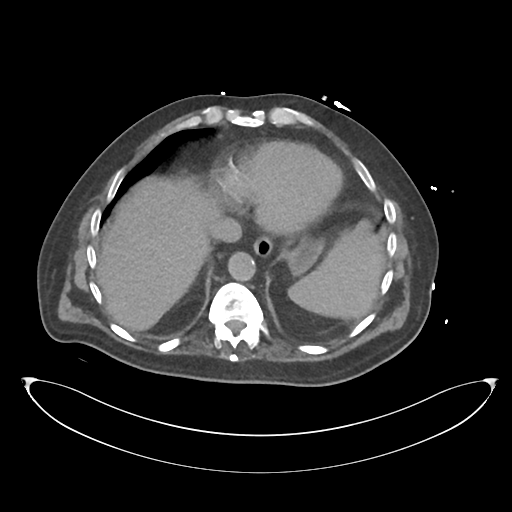 File:Obstructive pyelonephritis (Radiopaedia 46411-50844 Axial non-contrast 13).png