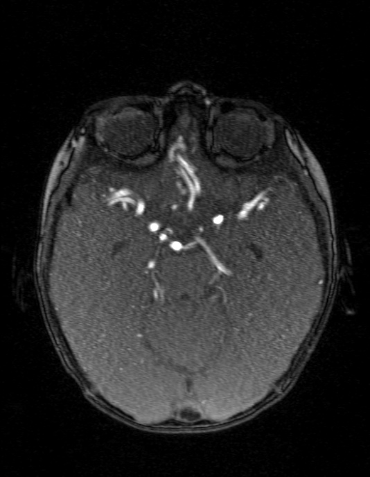 Occipital horn syndrome (Radiopaedia 14255-14129 MRA 60).jpg