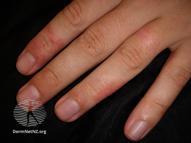 File:(DermNet NZ dermatitis-hand-dermatitis-2848).jpg