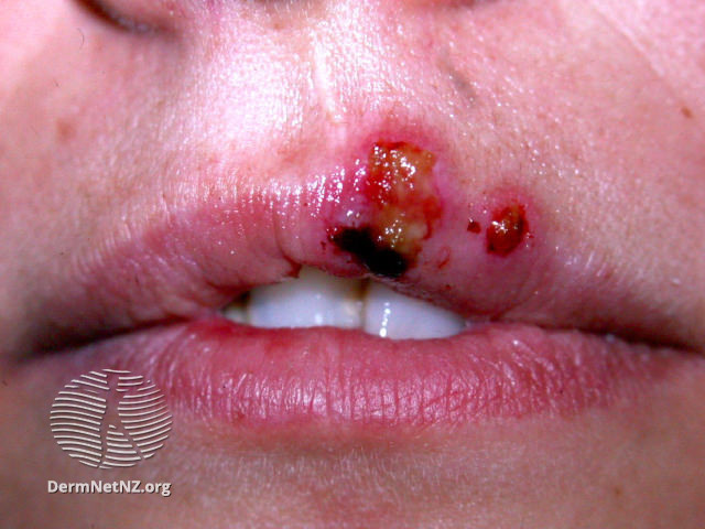 File:(DermNet NZ herpes-simplex-labialis-21).jpg