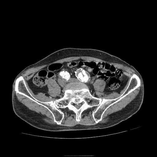 Abdominal aortic aneurysm (Radiopaedia 13341-13340 Axial C+ arterial phase 168).jpg