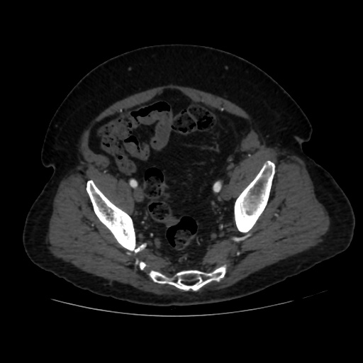 File:Abdominal aortic aneurysm (Radiopaedia 57318-64259 Axial C+ arterial phase 63).jpg