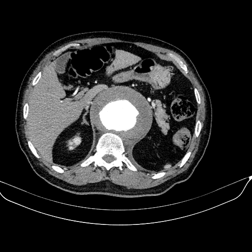 Abdominal aortic aneurysm (Radiopaedia 67117-76452 Axial C+ arterial phase 35).jpg