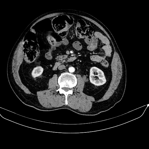 Abdominal aortic aneurysm (Radiopaedia 67117-76452 Axial C+ arterial phase 67).jpg