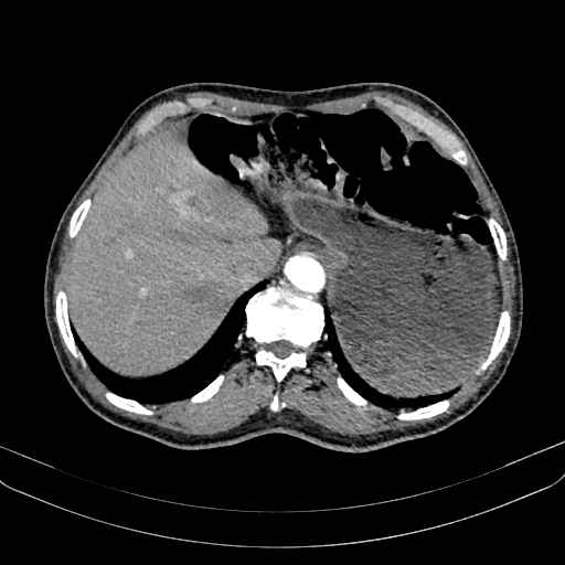 Abdominal aortic aneurysm (Radiopaedia 83581-98689 Axial C+ arterial phase 26).jpg
