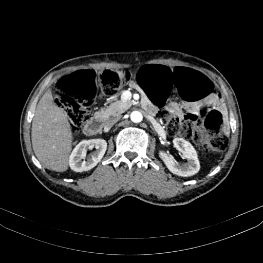 Abdominal aortic aneurysm (Radiopaedia 83581-98689 Axial C+ arterial phase 48).jpg