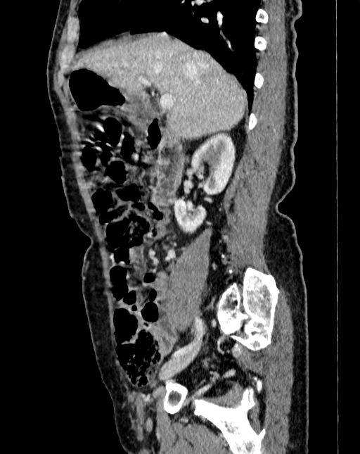 Abdominal aortic aneurysm (Radiopaedia 83581-98689 Sagittal C+ portal venous phase 12).jpg