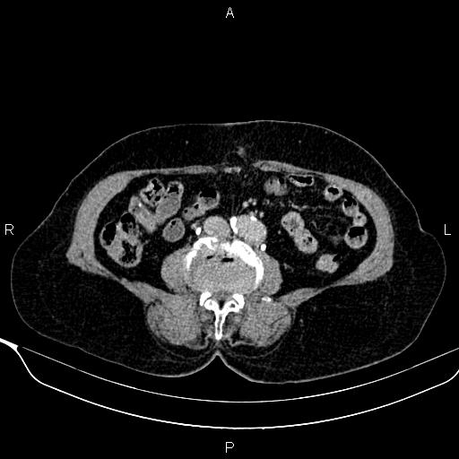 File:Abdominal aortic aneurysm (Radiopaedia 85063-100606 Axial C+ delayed 74).jpg