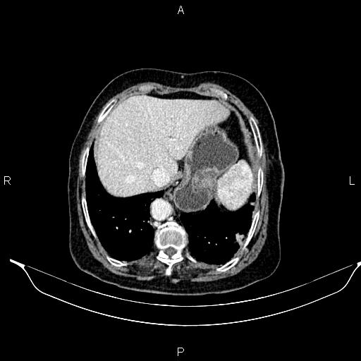 File:Abdominal aortic aneurysm (Radiopaedia 85063-100606 Axial C+ portal venous phase 28).jpg