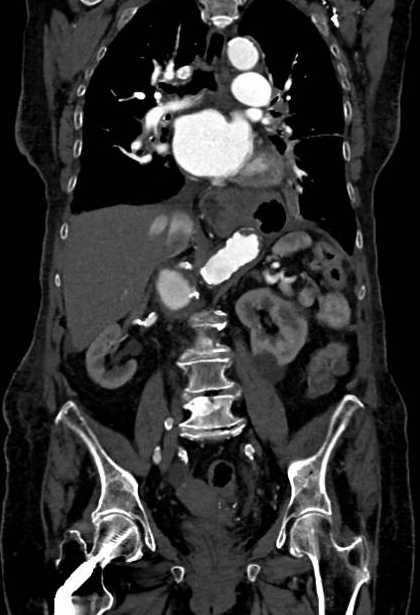 Abdominal aortic aneurysm with thrombus fissuration (Radiopaedia 73192-83919 Coronal C+ arterial phase 48).jpg
