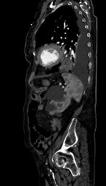 Abdominal aortic aneurysm with thrombus fissuration (Radiopaedia 73192-83919 Sagittal C+ arterial phase 31).jpg