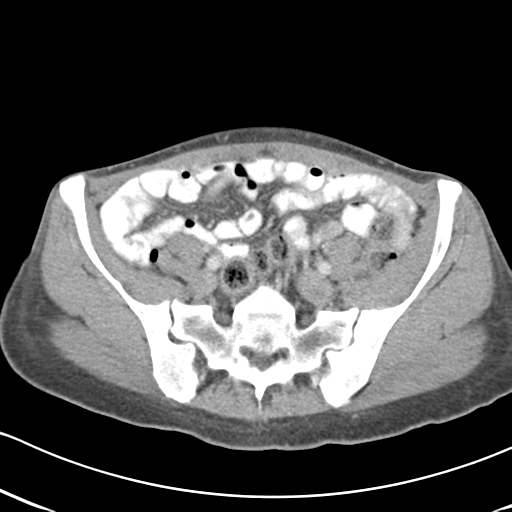 File:Abdominal desmoid tumor (Radiopaedia 41007-43740 Axial C+ portal venous phase 52).png