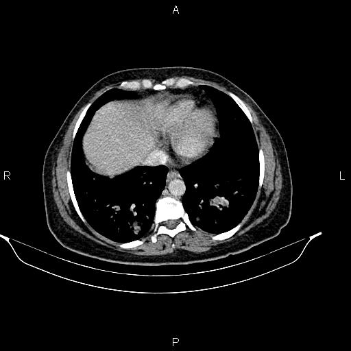 Abdominal lymphoma with sandwich sign (Radiopaedia 84378-99704 Axial C+ portal venous phase 6).jpg