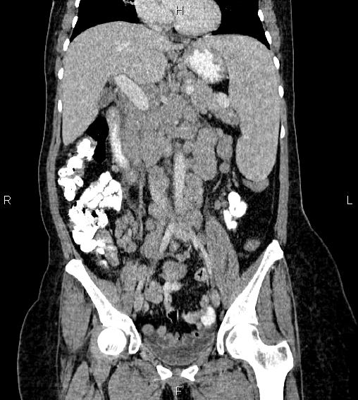 Abdominal lymphoma with sandwich sign (Radiopaedia 84378-99704 Coronal C+ portal venous phase 29).jpg