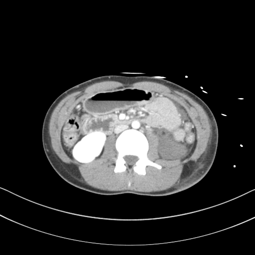 Abdominal multi-trauma - devascularised kidney and liver, spleen and pancreatic lacerations (Radiopaedia 34984-36486 Axial C+ portal venous phase 39).png
