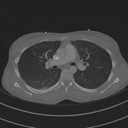 Abdominal multi-trauma - devascularised kidney and liver, spleen and pancreatic lacerations (Radiopaedia 34984-36486 I 37).png